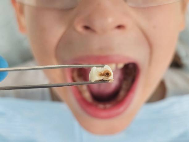 Best Emergency Wisdom Teeth Removal in Charlack, MO
